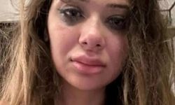 Merve Taşkın eski sevgilisinin şiddetine maruz kaldı